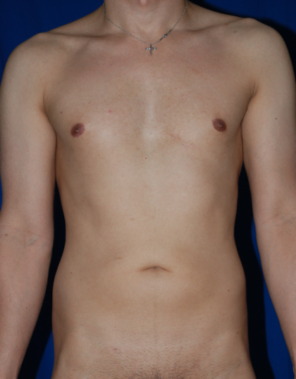 VASER Hi Def Liposuction Before & After Patient #4939