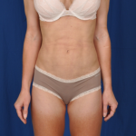 Standard Liposuction Before & After Patient #4955