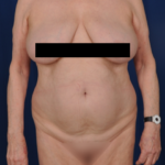 Standard Liposuction Before & After Patient #4962