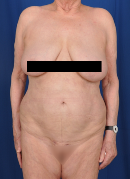 Standard Liposuction Before & After Patient #4962