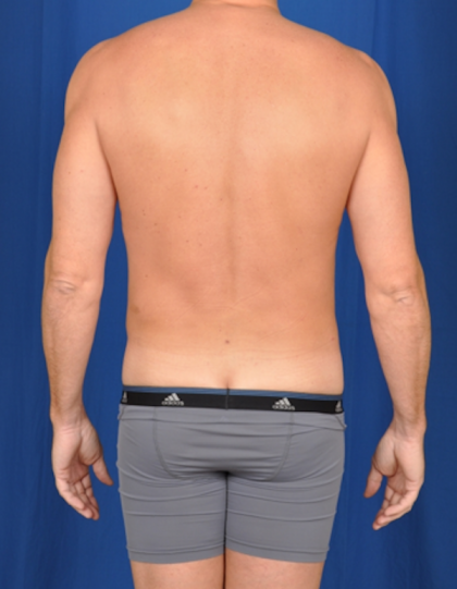 VASER Hi Def Liposuction Before & After Patient #4976