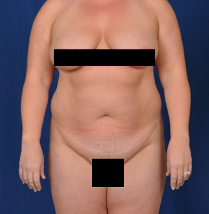 Standard Liposuction Before & After Patient #4992