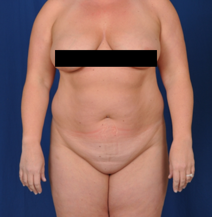 Standard Liposuction Before & After Patient #4992