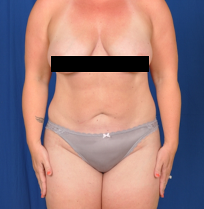 Standard Liposuction Before & After Patient #4992