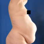 Standard Liposuction Before & After Patient #4999