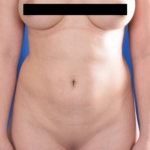 VASER Hi Def Liposuction Before & After Patient #5006