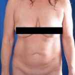Tummy Tuck Before & After Patient #5022