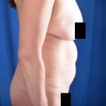 Tummy Tuck Before & After Patient #5022