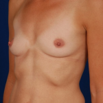 Breast Augmentation Before & After Patient #5029