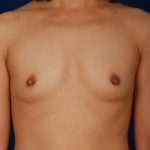 Breast Fat Transfer Before & After Patient #5032