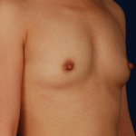 Breast Fat Transfer Before & After Patient #5032