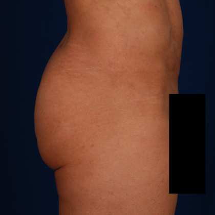 Fat Transfer Before & After Patient #5044