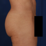 Fat Transfer Before & After Patient #5044