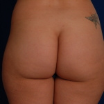 Fat Transfer Before & After Patient #5055