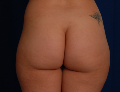 Fat Transfer Before & After Patient #5055