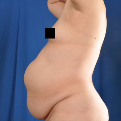 Standard Liposuction Before & After Patient #4999