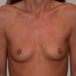 Breast Augmentation Before & After Patient #5094