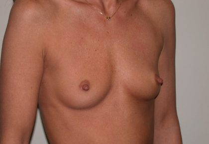 Breast Augmentation Before & After Patient #5094