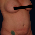 Tummy Tuck Before & After Patient #5123