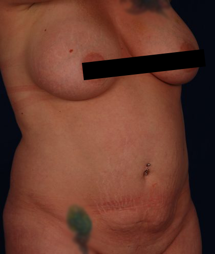 Tummy Tuck Before & After Patient #5123