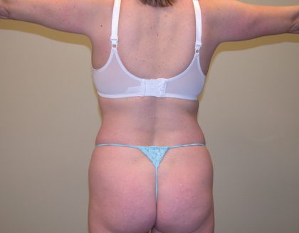 Standard Liposuction Before & After Patient #5113