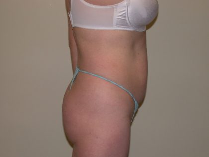 Standard Liposuction Before & After Patient #5113