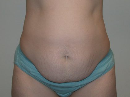 Tummy Tuck Before & After Patient #5159