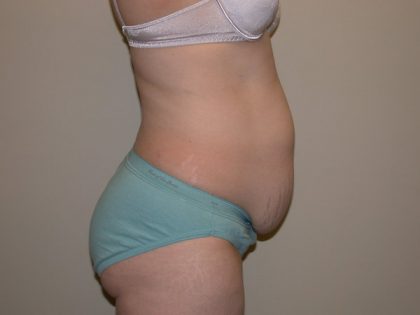 Tummy Tuck Before & After Patient #5159