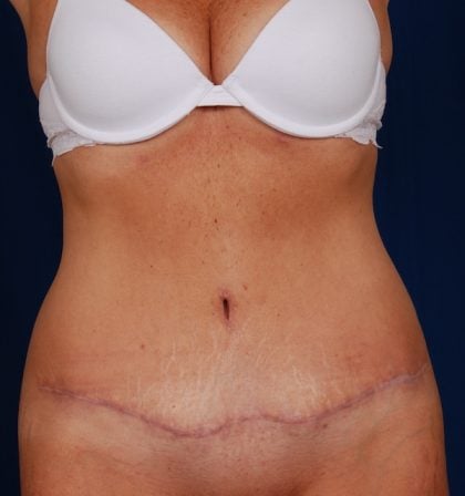 Tummy Tuck Before & After Patient #5122