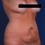 Tummy Tuck Before & After Patient #5122