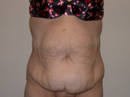 Tummy Tuck Before & After Patient #5132