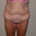 Tummy Tuck Before & After Patient #5133