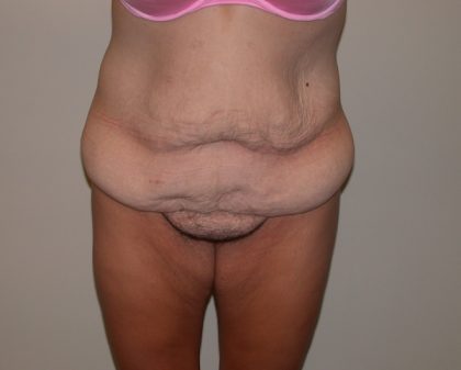 Tummy Tuck Before & After Patient #5133