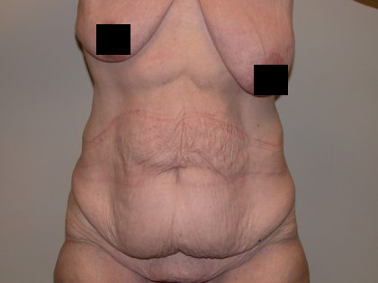 Tummy Tuck Before & After Patient #5138