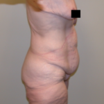 Tummy Tuck Before & After Patient #5138