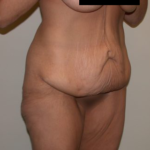 Tummy Tuck Before & After Patient #5139