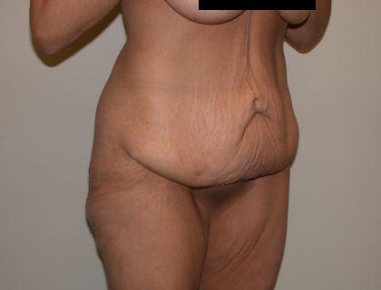 Tummy Tuck Liposuction in Denver  Millard, John ()