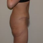 Tummy Tuck Before & After Patient #5139