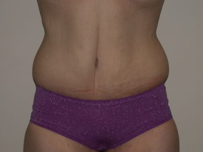Tummy Tuck Before & After Patient #5151