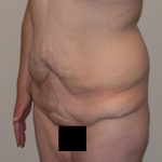 Tummy Tuck Before & After Patient #5151