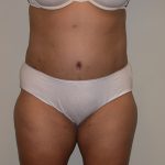 Tummy Tuck Before & After Patient #5158