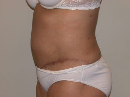 Tummy Tuck Before & After Patient #5158