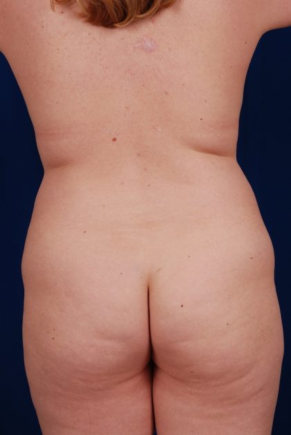 VASER Hi Def Liposuction Before & After Patient #5203