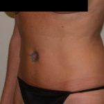VASER Hi Def Liposuction Before & After Patient #5223