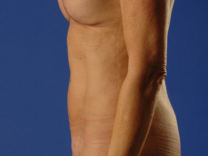 VASER Hi Def Liposuction Before & After Patient #5223