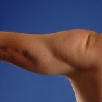 Arms Liposuction Before & After Patient #5190