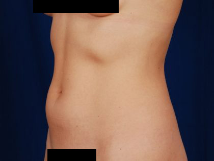 VASER Hi Def Liposuction Before & After Patient #5196