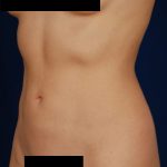 VASER Hi Def Liposuction Before & After Patient #5196