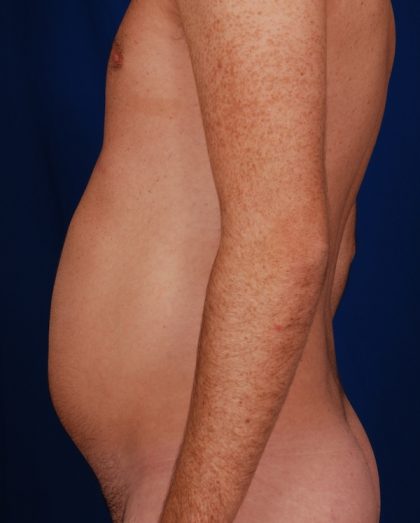 VASER Hi Def Liposuction Before & After Patient #5197