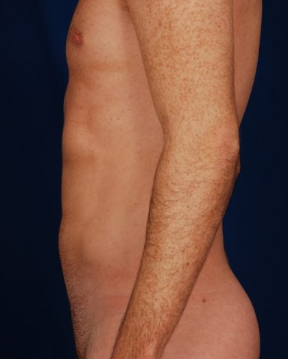 VASER Hi Def Liposuction Before & After Patient #5197